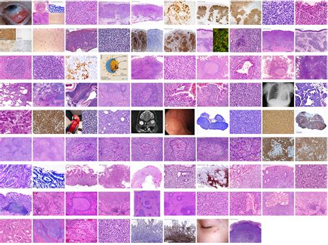 webpathology|webpathology lung.